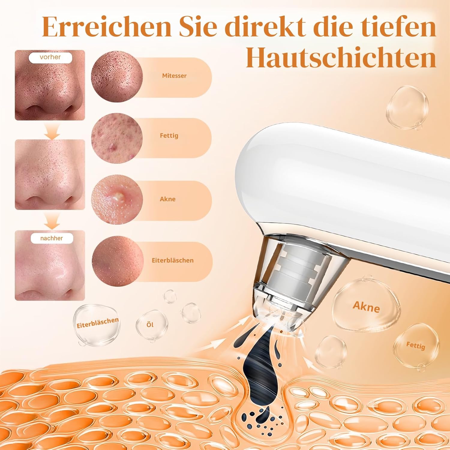 Yccu Mitesser-Entferner, Porenreiniger, Porenreiniger, 4 Modi, Pickel-Absaugung, Vakuum-Absaugung für Gesichtsreinigung, Akne-Behandlung, Mitesser-Sauger, Hautpflege – Bild 3